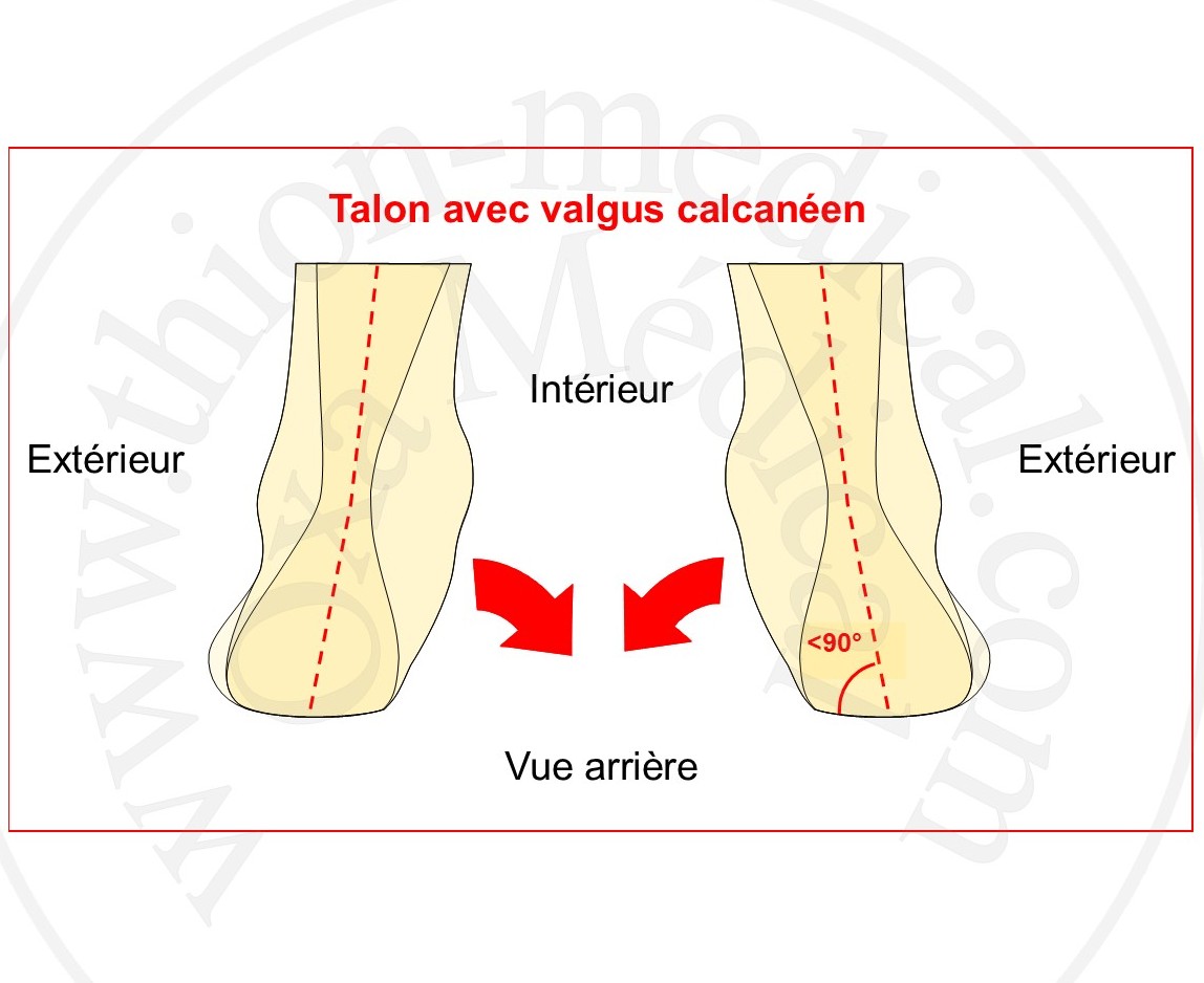 Schéma du talon avec valgus calcanéen